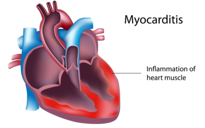 Обзорная статья “Myocarditis” в New England Journal Of Medicine 2022